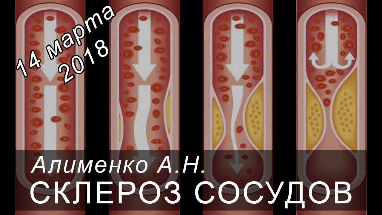 Склероз сосудов. Алименко А.Н. (14.03.2018) смотреть онлайн