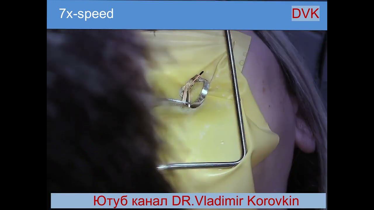 Латеральная конденсация канала 25 зуба. Скорость 7х.