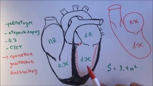 Стеноз устья аорты (аортальный стеноз)