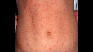 Виды псориаза.