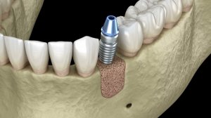 Хирургия аугментации — добавление новой кости и имплантата