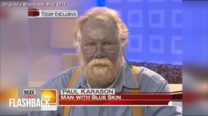 Why This Man’s Skin Turned Blue