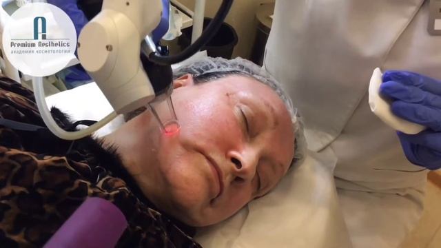 Лазерный пилинг на аппарате ACUPULSE с Шилиной Татьяной. 13.02.2019. смотреть онлайн