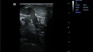 Перфорантная вена подколенной ямки с варикозной трансформацией подкожных вен в ее бассейне.