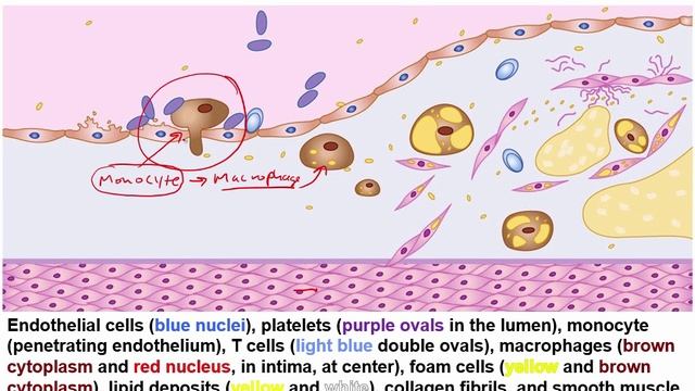 USMLE RX - 2.Кардиология - 3.Патология - 6.Атеросклероз