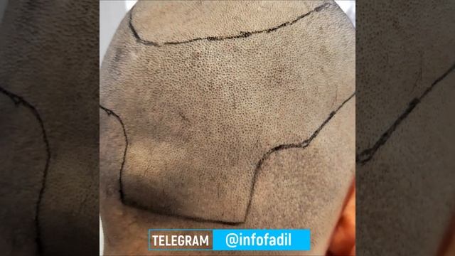 Пересадка волос 4100 графт | Гость из Казахстана