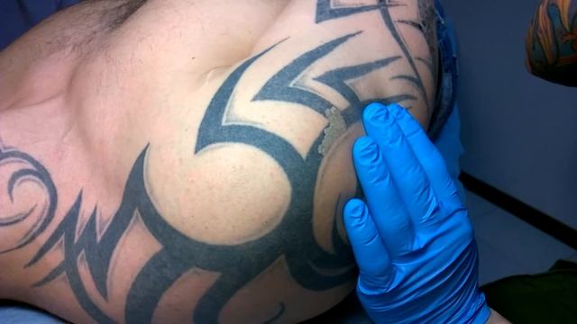 Осветление татуировок неодимовым лазером смотреть онлайн