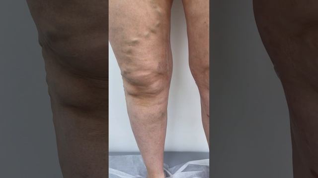 Варикоз. Как лечить варикоз? Лечение варикоза. Флеболог Москва. Флеболог. Сосудистый хирург смотреть онлайн