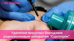 Удаление вирусных бородавок радиоволновым аппаратом "Сургитрон" в ОН КЛИНИК.
