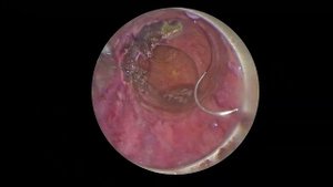 Ушивание дефекта прямой кишки после удаления полипа.