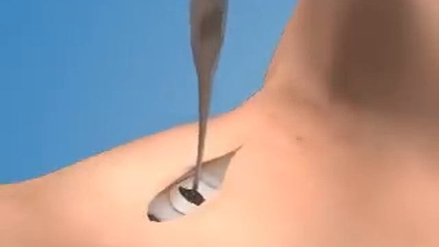 Крикотиротомия коникотомия 3D  компьютерная анимация смотреть онлайн