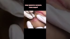 Самое залипательное видео давить прыщи Черные точки