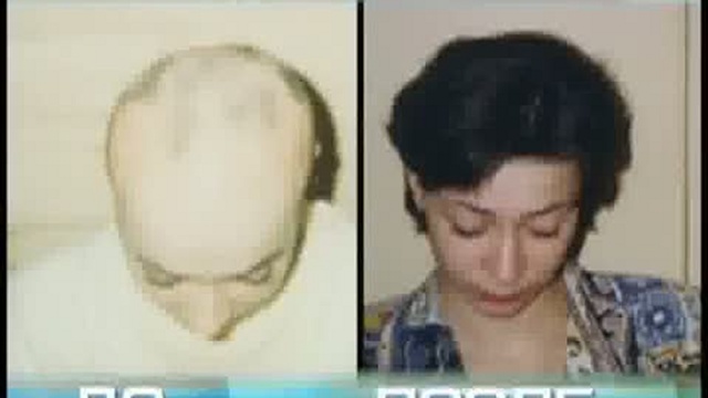 Лечение облысения