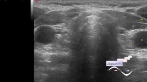 УЗИ щитовидной железы - Гипоплазия левой доли ЩЖ