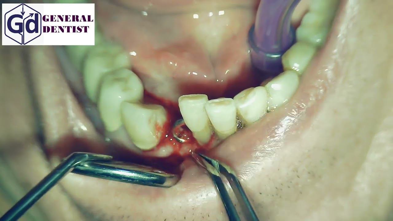 Insertion gingiva former  in area 42.