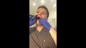 Self-extraction of an upper right wisdom tooth\Удаление верхнего зуба мудрости(восьмерки)