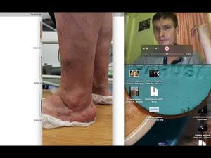 На приеме у флеболога: Тендовагинит малоберцовой мышцы, диагностика