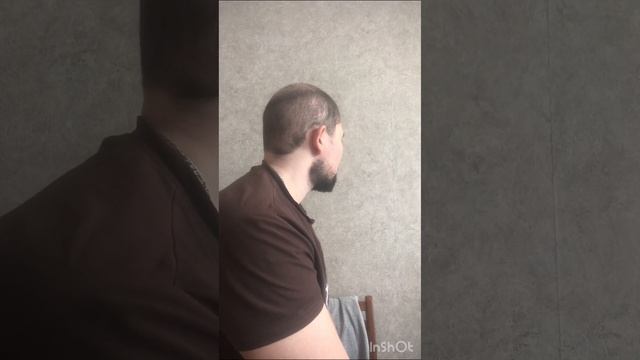 35 Дней по трансплантации волос в Турции #обзорволос #пересадка #результатпересадкиволос