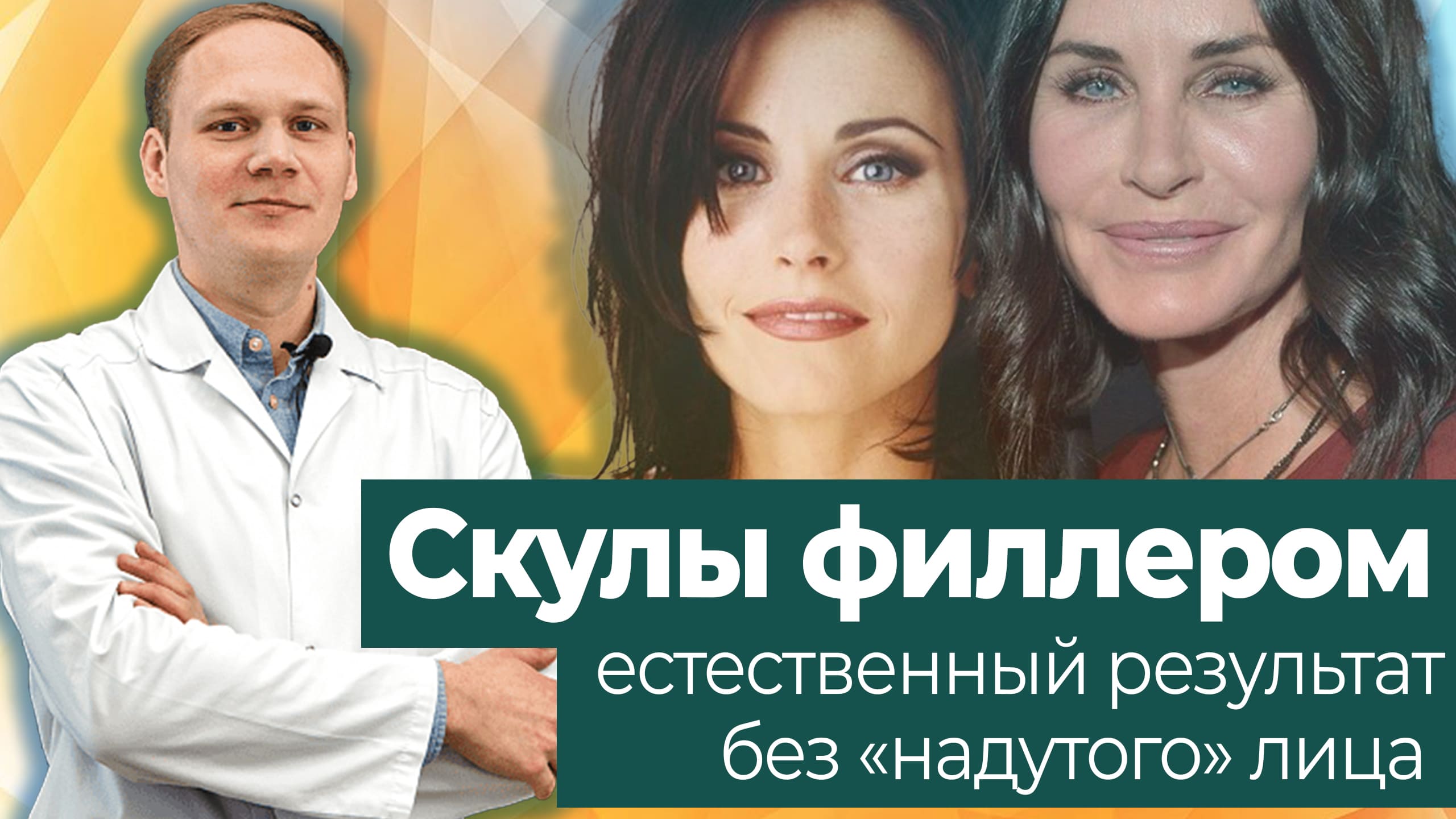 Скулы филлером