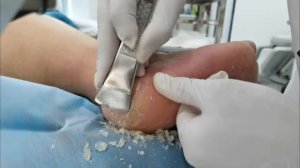 Remove Heel Fissure slowly & carefully. Cracked heel treatment & Callus removal. Dead skin removal.