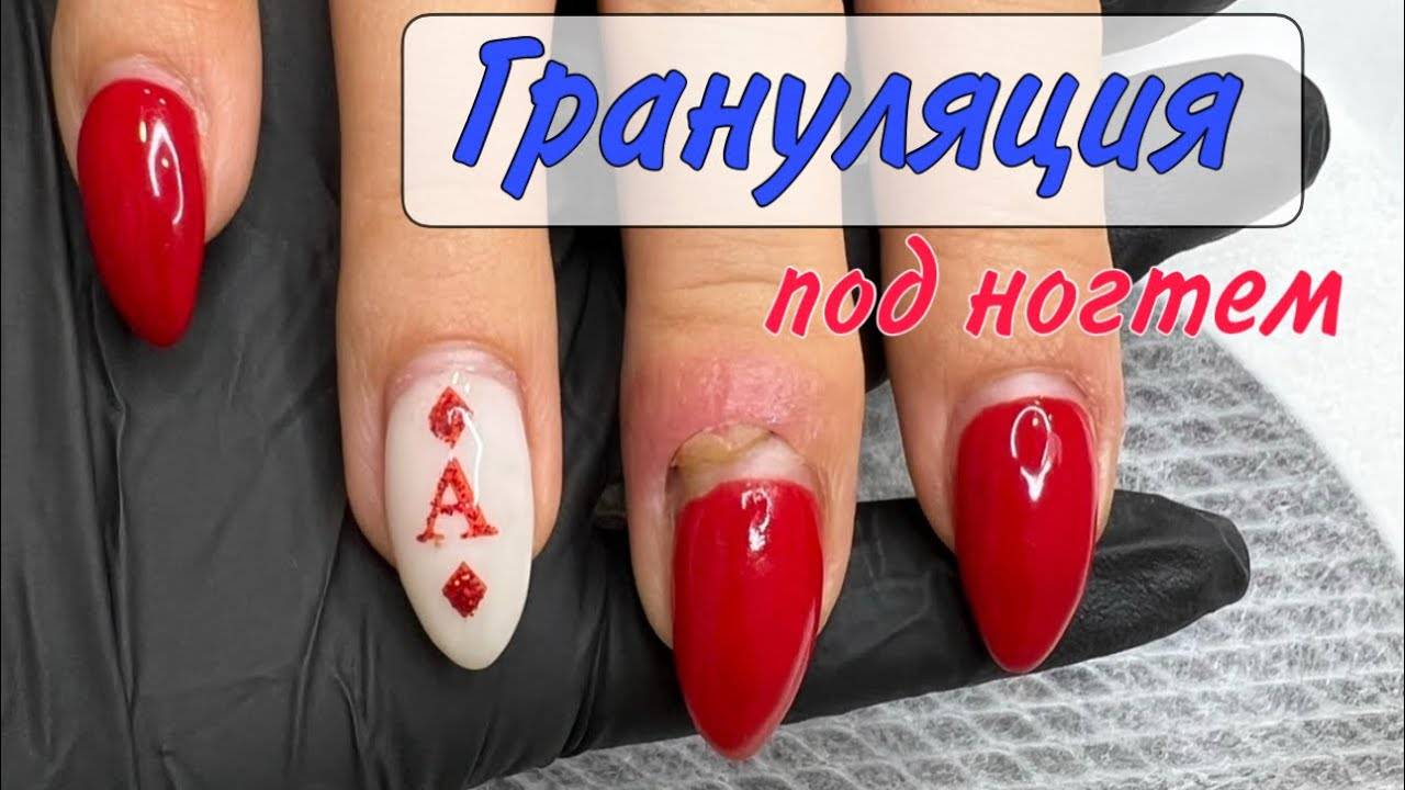 Рана под ногтем _ грануляция под кутикулой _ трещина на ногте