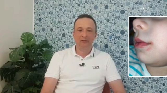 Летнее обострение розовых угрей| Периоральный дерматит| Клиника 