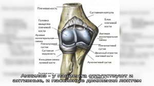 Контрактура локтевого сустава
