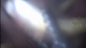 удаление мочеточникового катетера