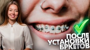 Какие ощущения вызывают брекеты у пациентов сразу после их установки? Брекеты. Исправление прикуса.