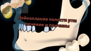Лейкоплакия полости рта: лечение и причины