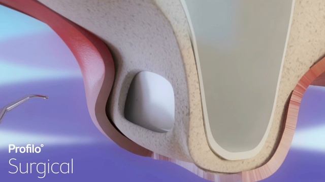 Dental Implants  Sinus Lift  Bone Graft
