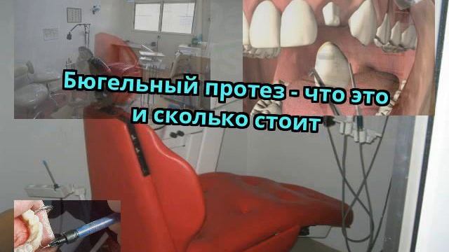Бюгельный протез - что это и сколько стоит