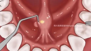 ASMR Get Rid of Bad Breath! Tonsil Stone Removal, Salivary Glands Cleaning | Meng's Stop Motion