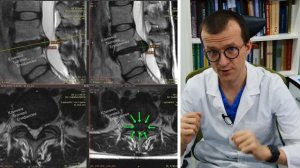 ВЫЛЕЧИЛИ ГРЫЖУ ДИСКА L4-L5