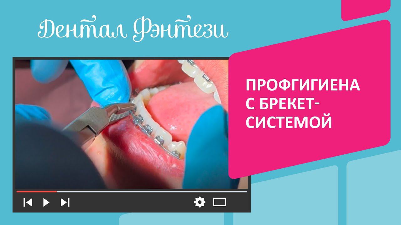  Профессиональная чистка зубов с брекет-системой