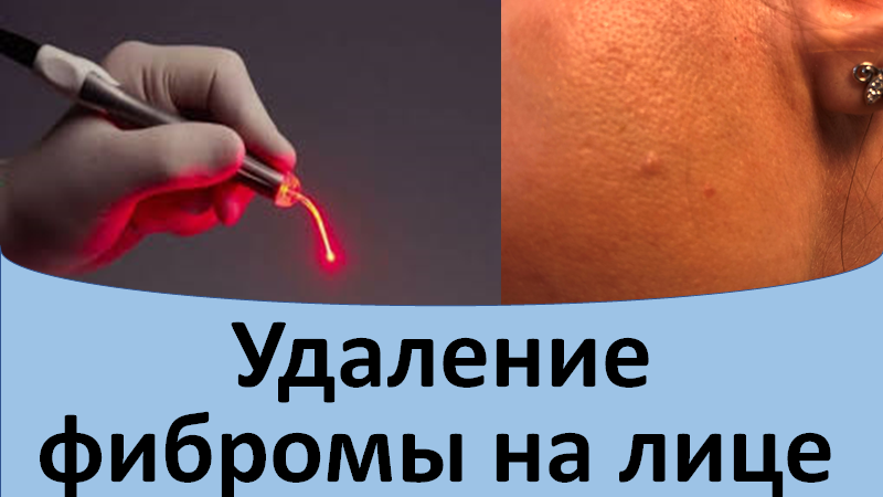 Удаление фибромы на лице.
