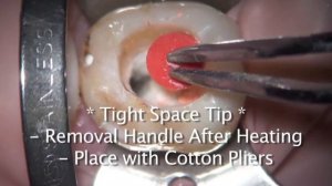 Full GuttaCore® Placement Technique with Dr. Landwehr