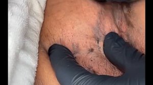 Blackhead and clogged Underarm extractions on HS client