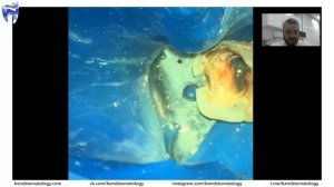 Вебинар. Перелечивание (резорцин-формалин). Эндодонтия. Андрей Афанютин