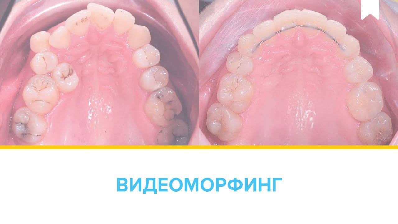 Лечение скученности с удалением — достаточно длительное, но эффективное!