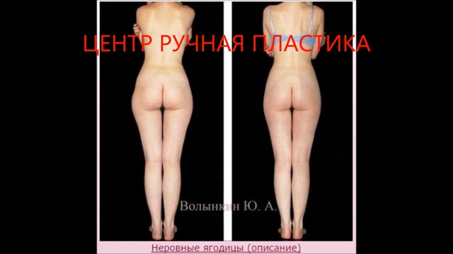 Центр Ручная Пластика ⁄ Красота вопреки природе ⁄ Эстетическая Медицина ¦ Альтернатива липосакции