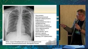 51 Рентгенологическая визуализация туберкулеза Гаврилов Павел Владимирович