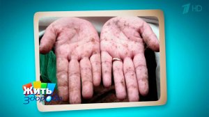 Три теста при темных пятнах на коже. Жить здорово! Фрагмент выпуска от 29.07.2016