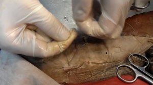 Остановка кровотечения путем перевязки