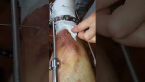 Аппарат Илизарова