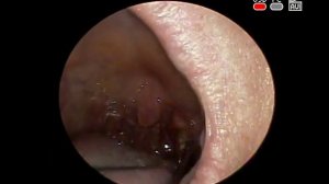 ПРОМЫВАНИЕ  #МИНДАЛИН #ПРОБКИ STONE REMOVAL TONSIL LAVAGE ХРОНИЧЕСКИЙ #ТОНЗИЛЛИТ ЛОР ВРАЧ