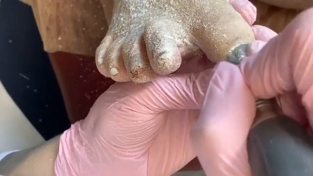 Онихогрифоз