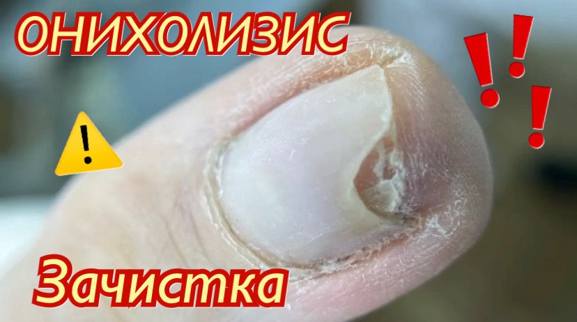 Онихолизис ⚠️❗️? • Зачистка???