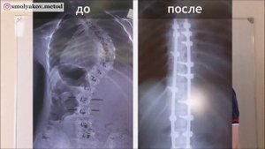 Операция на позвоночнике грыжа удаление и статистика ухудшения